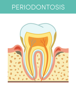 Periodontosis