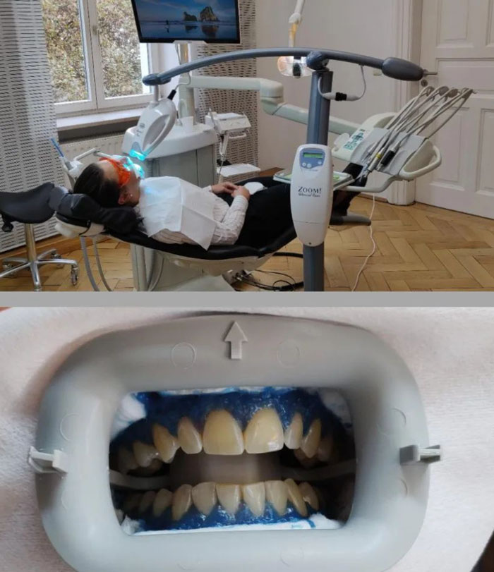Bleaching in der Zahnarztpraxis