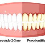 Parodontitis