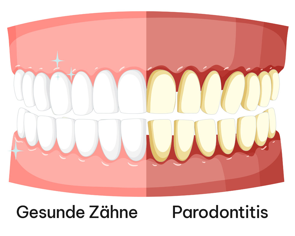 Parodontitis: Ursachen & Behandlung