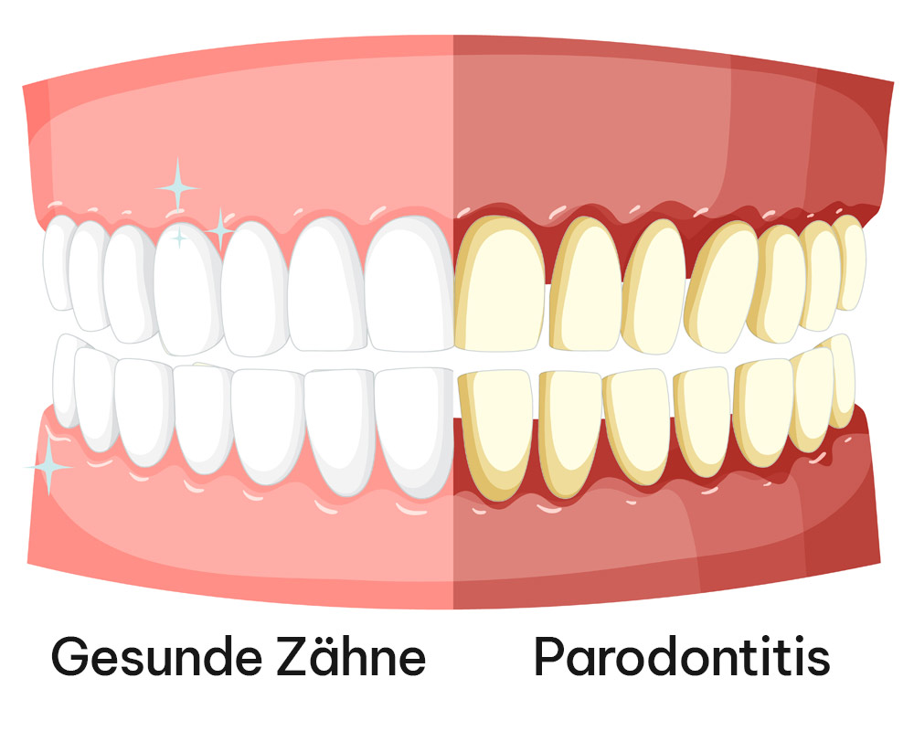 Parodontitis