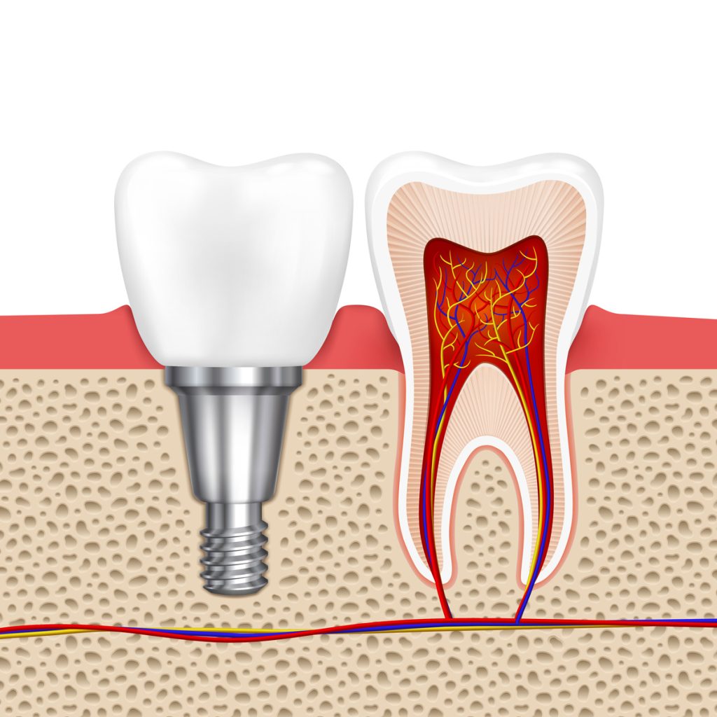 Zahnimplantat links- normaler Zahn rechts